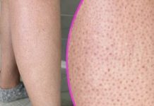 OVE TAČKICE NA NOGAMA VAM KVARE LJETO? Evo kako da ih se riješite, koža će vam biti glatka