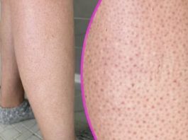 OVE TAČKICE NA NOGAMA VAM KVARE LJETO? Evo kako da ih se riješite, koža će vam biti glatka