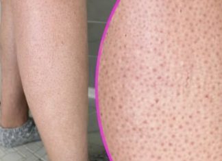 OVE TAČKICE NA NOGAMA VAM KVARE LJETO? Evo kako da ih se riješite, koža će vam biti glatka
