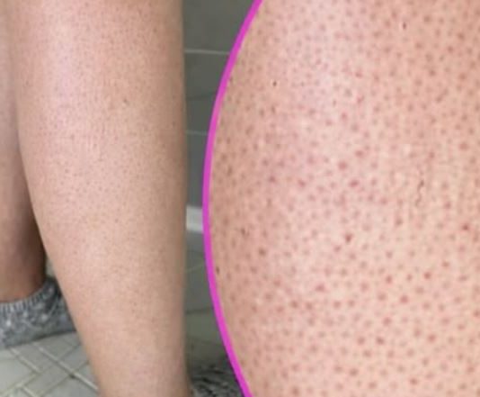 OVE TAČKICE NA NOGAMA VAM KVARE LJETO? Evo kako da ih se riješite, koža će vam biti glatka
