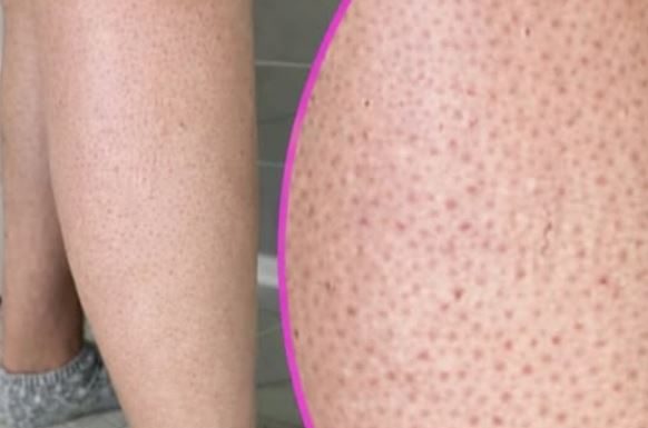 OVE TAČKICE NA NOGAMA VAM KVARE LJETO? Evo kako da ih se riješite, koža će vam biti glatka