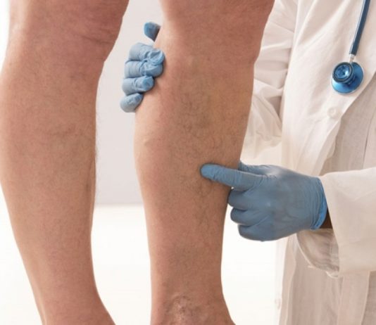 Prvi simptomi KRVNOG UGRUŠKA djeluju bezazleno – Ako imate OVE promjene na tijelu, ne smijete ih nikako ignorisati