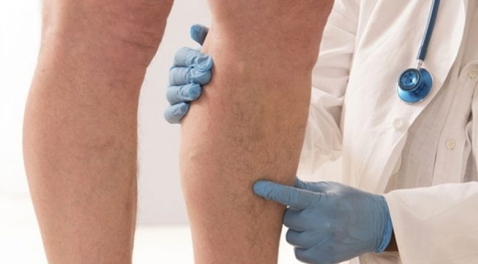 Prvi simptomi KRVNOG UGRUŠKA djeluju bezazleno – Ako imate OVE promjene na tijelu, ne smijete ih nikako ignorisati