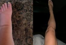 Upute kako da IZBACI VIŠAK VODE IZ TELA: Vaša stopala će prestati da otiču kada to uradite!