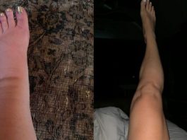 Upute kako da IZBACI VIŠAK VODE IZ TELA: Vaša stopala će prestati da otiču kada to uradite!