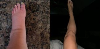 Upute kako da IZBACI VIŠAK VODE IZ TELA: Vaša stopala će prestati da otiču kada to uradite!