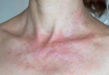 IMATE LI ALERGIJU NA SUNCE? Evo koji su simptomi i kako ih prirodno eliminirati