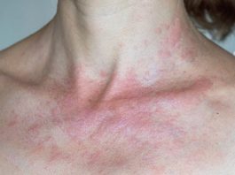 IMATE LI ALERGIJU NA SUNCE? Evo koji su simptomi i kako ih prirodno eliminirati