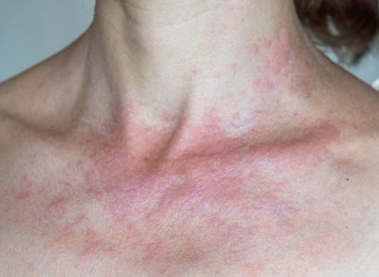 IMATE LI ALERGIJU NA SUNCE? Evo koji su simptomi i kako ih prirodno eliminirati