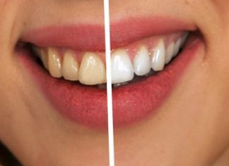 Najjači PRIRODNI LIJEK za uklanjanje ZUBNOG KAMENCA