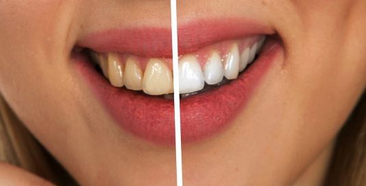 Najjači PRIRODNI LIJEK za uklanjanje ZUBNOG KAMENCA