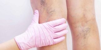 TIHI UBICA S PREDUMIŠLJAJEM: Duboka venska tromboza, neliječena, može da ima i FATALAN ISHOD! Evo koji su simptomi!