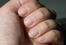 Odličan” način da prepoznate visok nivo holesterola: Nokti mogu da ga odaju, obratite pažnju na dve stvari….