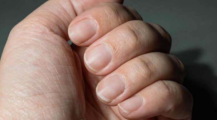 Odličan” način da prepoznate visok nivo holesterola: Nokti mogu da ga odaju, obratite pažnju na dve stvari….