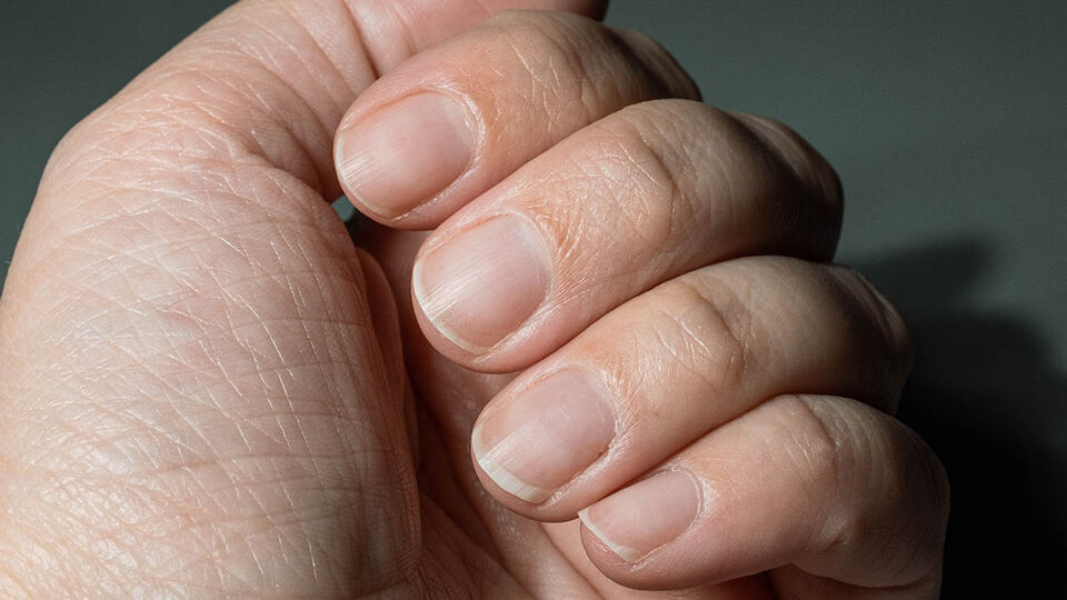 Overgrown,Unkempt,Nails,On,A,Woman's,Hand,With,A,Dry