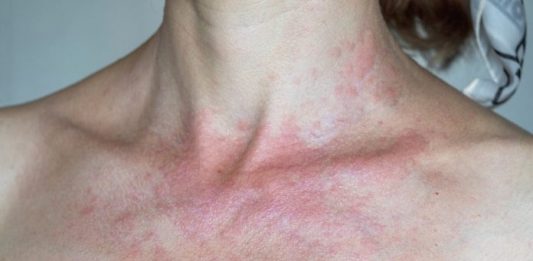 IMATE LI ALERGIJU NA SUNCE? Evo koji su simptomi i kako ih prirodno eliminirati