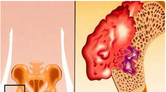 Bol u kostima, visok pritisak i tuga: Tijelo vam govori da mu NEDOSTAJE ovaj važan VITAMIN