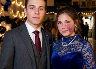 Samo jedan dečko me je pozvao na matursko veče, jer niko drugi nije želeo da ide sa mnom zbog mladeža na mom licu – svi su se smejali, sve dok policajac nije ušao u salu