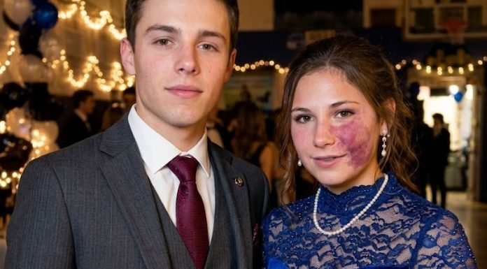 Samo jedan dečko me je pozvao na matursko veče, jer niko drugi nije želeo da ide sa mnom zbog mladeža na mom licu – svi su se smejali, sve dok policajac nije ušao u salu