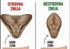 Ako Vas zmija ujede prvo uradite ovo!!!