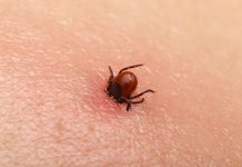 Bezbolno je i nema čupanja: Doktorka otkrila trik kako da se krpelj sam otkači sa kože (video)