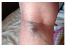 NAMIRNICE KOJE POVEĆAVAJU RIZIK OD TROMBOZE, JEDNA POSEBNO:Jedemo ih svakoga dana, a štete arterijama NAMIRNICE KOJE POVEĆAVAJU RIZIK OD TROMBOZE, JEDNA POSEBNO:Jedemo ih svakoga dana, a štete arterijama - featured image