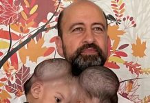 Od jedne glave do dva odvojena života: kako su Manal i Mirha dobile novu šansu poslije zahtjevne operacije Od jedne glave do dva odvojena života: kako su Manal i Mirha dobile novu šansu poslije zahtjevne operacije - featured image