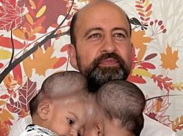 Od jedne glave do dva odvojena života: kako su Manal i Mirha dobile novu šansu poslije zahtjevne operacije Od jedne glave do dva odvojena života: kako su Manal i Mirha dobile novu šansu poslije zahtjevne operacije - featured image