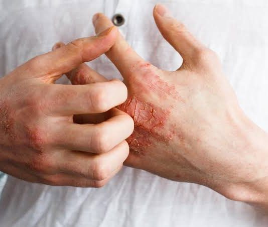 Umor, svrab, VISOK KRVNI PRITISAK, BOL U LEĐIMA – Ova bolest je ”TIHI UBICA”, obratite pažnju ako imate neke od ovih simptoma