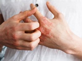 Umor, svrab, VISOK KRVNI PRITISAK, BOL U LEĐIMA – Ova bolest je ”TIHI UBICA”, obratite pažnju ako imate neke od ovih simptoma